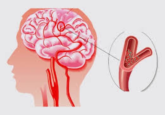 Cơn thiếu máu não thoáng qua | Tầm soát đột quỵ Tân Phú