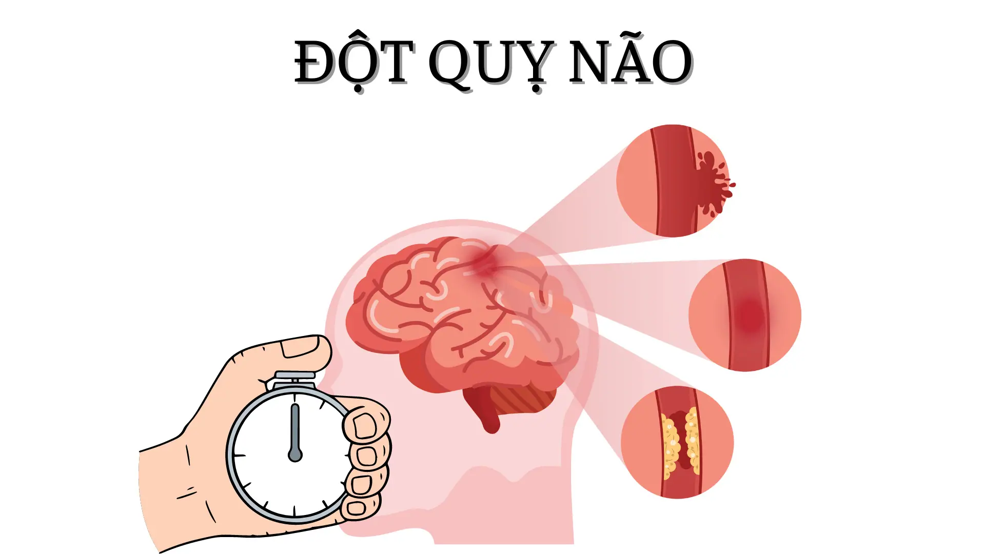 Yếu tố nguy cơ hàng đầu gây đột quỵ ở người Việt Yếu tố nguy cơ hàng đầu gây đột quỵ ở người Việt