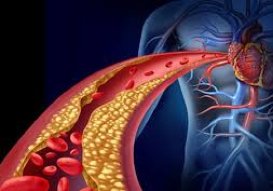 Rối loạn mỡ máu là gì? Nguyên nhân, triệu chứng và cách dự phòng?