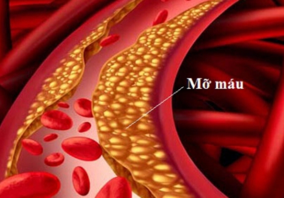 Atorvastatin trong điều trị rối loạn mỡ máu
