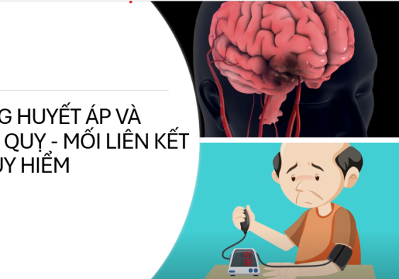 Tăng huyết áp và Đột quỵ - Mối liên kết nguy hiểm