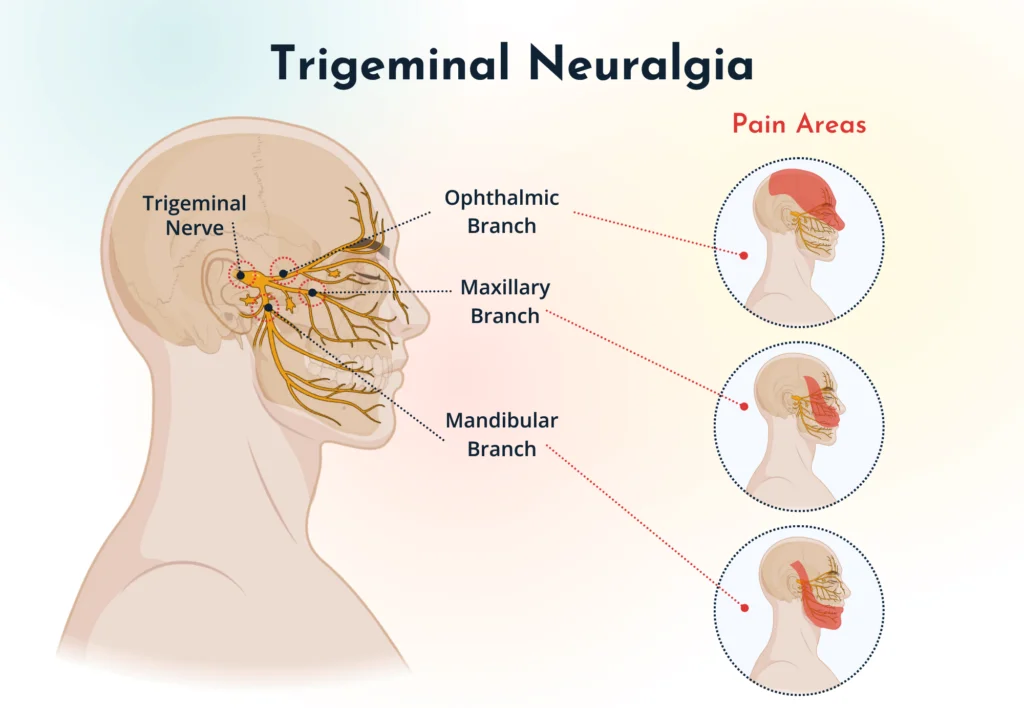ĐAU DÂY THẦN KINH MẶT: BỆNH LÝ DỄ NHẦM LẪN VÀ THƯỜNG BỊ BỎ SÓT
