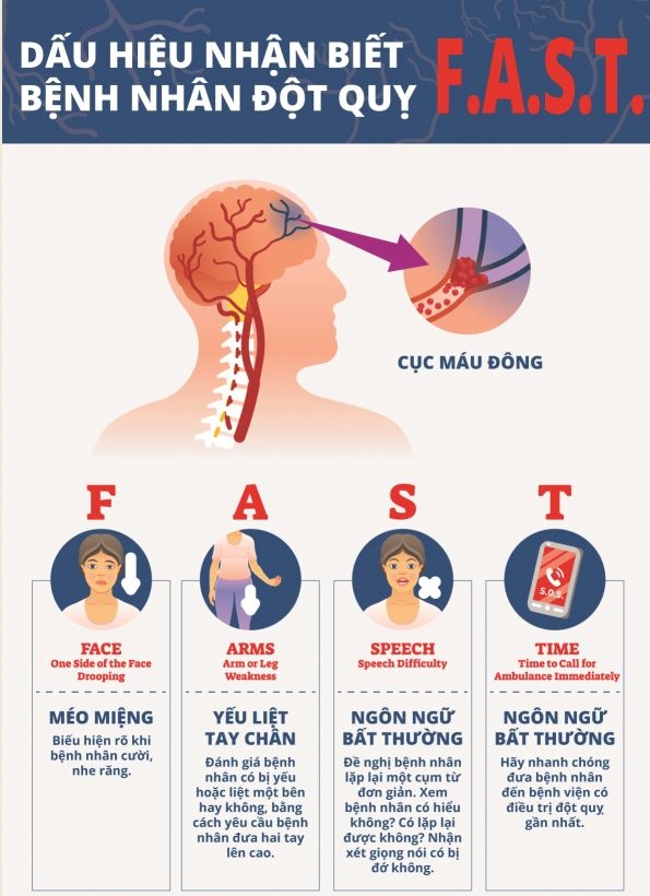 TRIỆU CHỨNG CẢNH BÁO ĐỘT QUỴ FAST