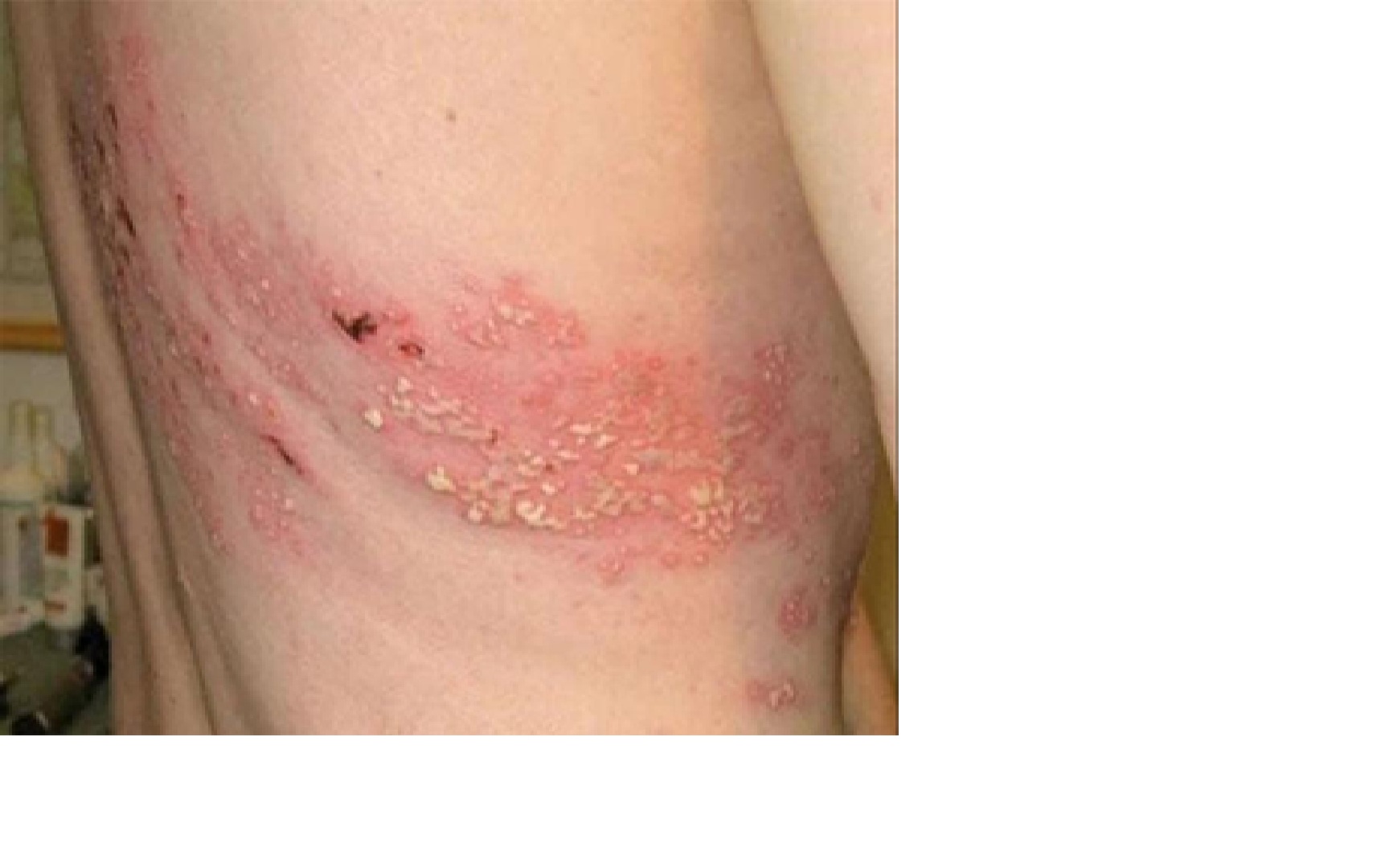 zona-than-kinh-điều-trị-zona-thần-kinh-đau-sau-zona