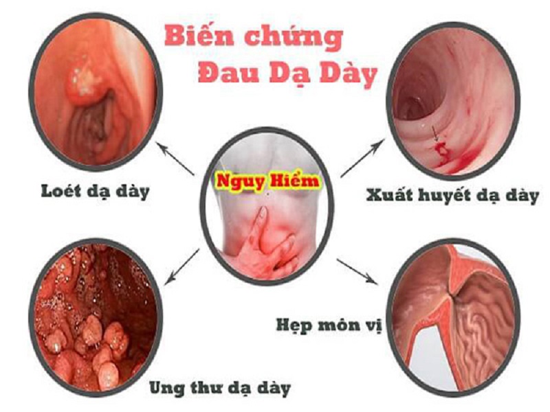 Biến chứng nguy hiểm của viêm dạ dày