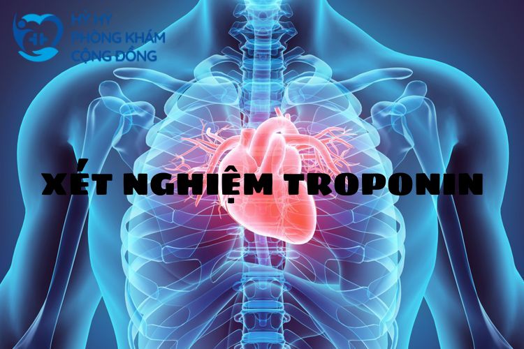 Xét nghiệm Troponin
