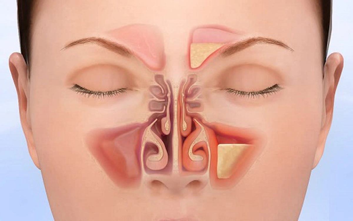 Tai - Mũi - Họng tại hỷ hỷ