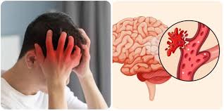 Dấu Hiệu Đột Quỵ Nhẹ Thường Gặp Nhất