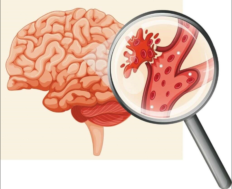 Quy Trình Khám Tầm Soát Đột Quỵ Chuyên Nghiệp Tại Phòng Khám Hỷ Hỷ