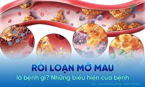 Rối loạn mỡ máu là gì? Nguyên nhân, triệu chứng và cách dự phòng?