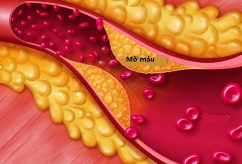 Rối loạn mỡ máu