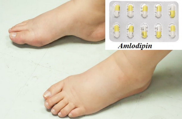 Hình ảnh cổ chân bị phù do dùng thuốc trị huyết áp