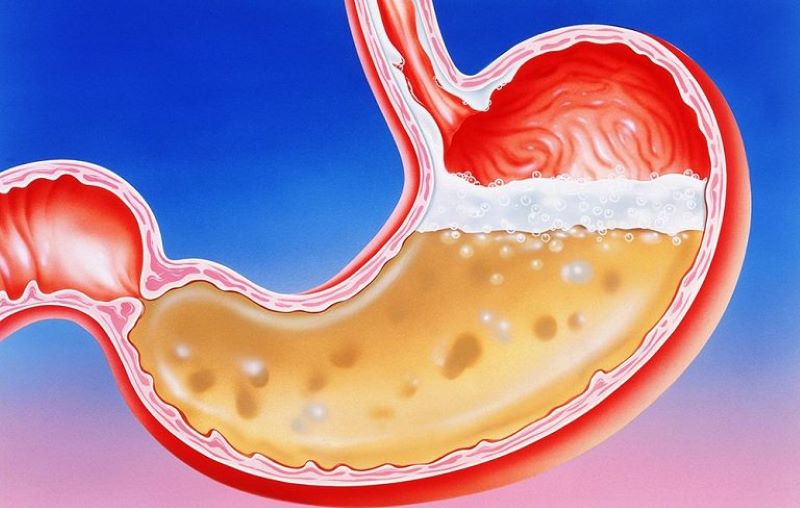 Antacid giúp trung hòa dịch acid trong dạ dày