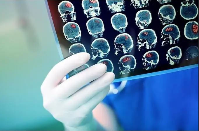 Vì Sao Người Cao Tuổi Lại Là Đối Tượng Nguy Cơ Hàng Đầu Của Tai Biến Mạch Máu Brain?