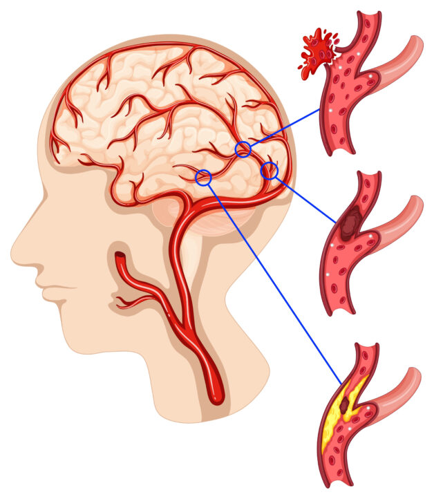 Đột quỵ thiếu máu não
