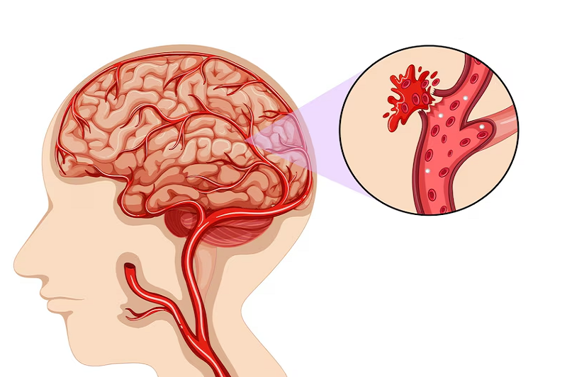 Đột quỵ xuất huyết não