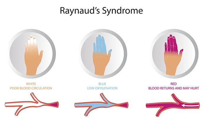 Hội chứng Raynaud