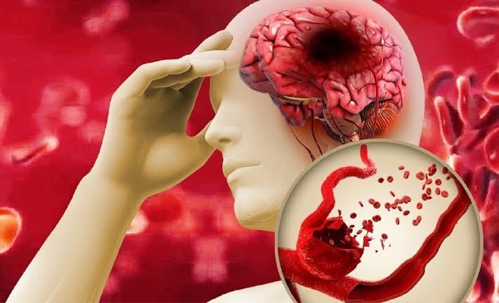 Những Đối Tượng Bắt Buộc Nên Thực Hiện Khám Tầm Soát Đột Quỵ