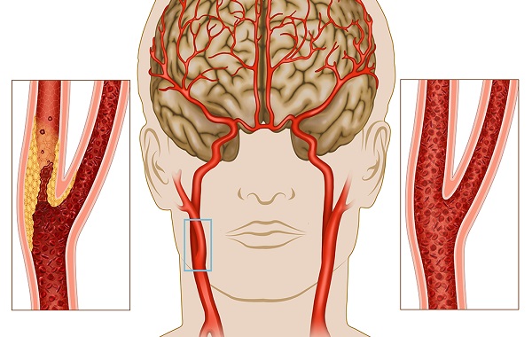 Đột Quỵ Thiếu Máu Não Thực Chất Là Gì?