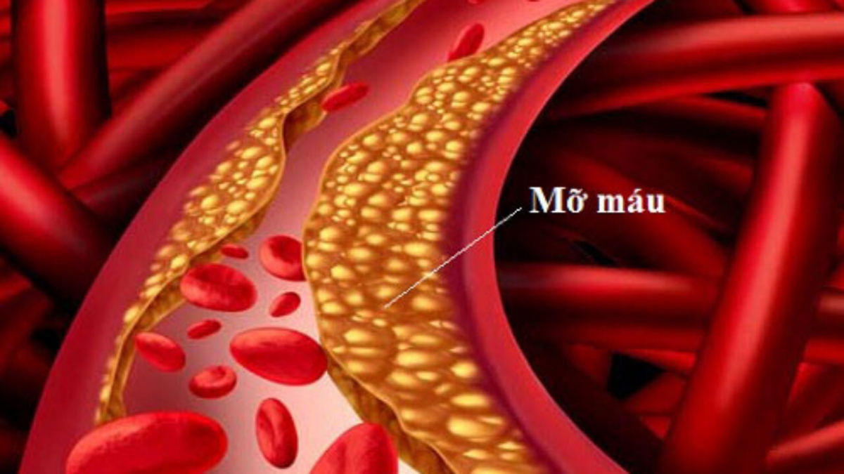 Rối loạn mỡ máu