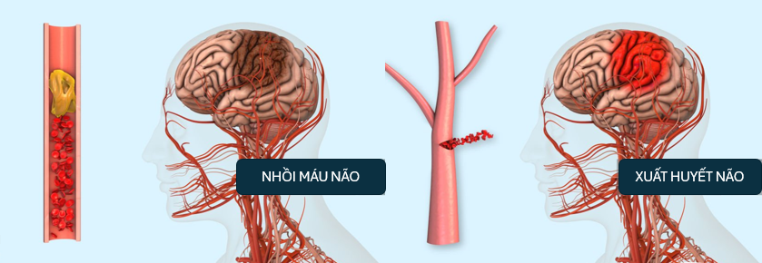 Đột quỵ nhồi máu não và đột quỵ xuất huyết não
