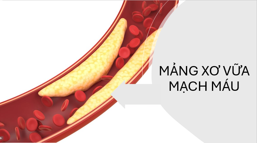 mảng xơ vữa động mạch