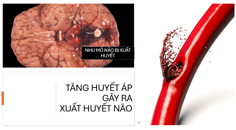 Tăng huyết áp và Đột quỵ - Mối liên kết nguy hiểm