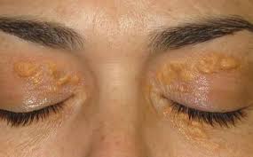 Rối loạn mỡ máu là gì? Nguyên nhân, triệu chứng và cách dự phòng?
