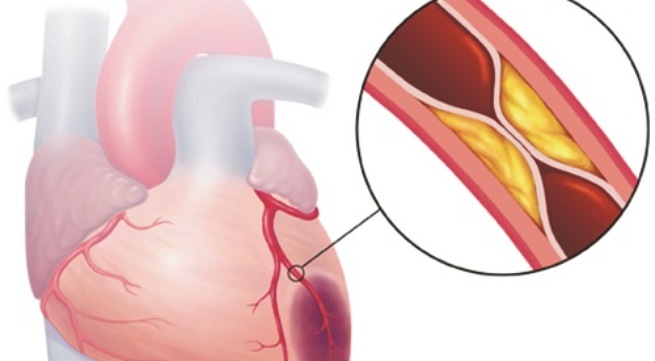 Xét nghiệm mỡ máu